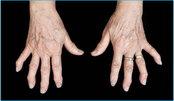 arthrose des mains