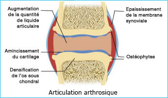 articulations arthrosique