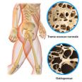 Arthrose et ostéoporose