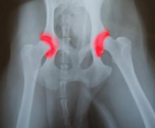 arthrose de hanche et radiographie